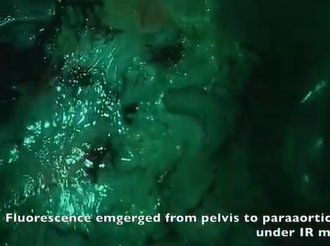 Lymph Node Mapping & Anastomosis Evaluation by Infrared Fluorescence in Laparoscopic Rectal Surgery Lymph Node Mapping & Anastomosis Evaluation by Infrared Fluorescence in Laparoscopic Rectal Surgery