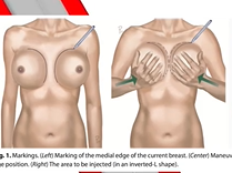 Making Perfect Cleavage with Fat: Plastic Surgery Hot Topics with Rod J. Rohrich, MD Making Perfect Cleavage with Fat: Plastic Surgery Hot Topics with Rod J. Rohrich, MD
