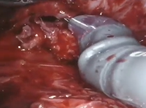 Management of Multiple Ureteral Strictures in a Partially Duplicated Collecting Syst Management of Multiple Ureteral Strictures in a Partially Duplicated Collecting Syst