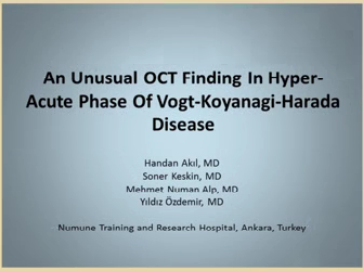 Management of Retinal Non-perfusion - An Unusual OCT Finding In Hyper-Acute Phase Of Vogt-Koyanagi-Harada Disease Management of Retinal Non-perfusion - An Unusual OCT Finding In Hyper-Acute Phase Of Vogt-Koyanagi-Harada Disease
