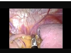 Management Of Splenic Aneurysms With Stent And Splenectomy