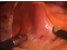 Masqueraders: Distal Esophageal Leiomyomata Mimicking Esophageal Motility Disorders Masqueraders: Distal Esophageal Leiomyomata Mimicking Esophageal Motility Disorders