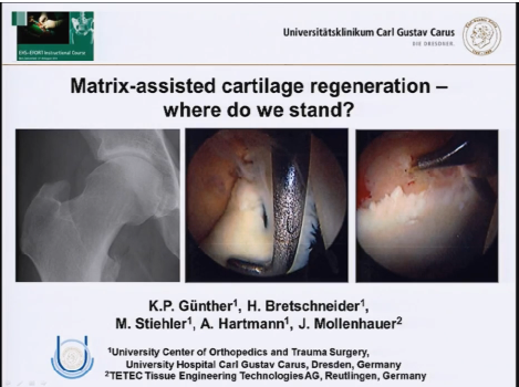 Matrix assisted cartilage regeneration - where do we stand?