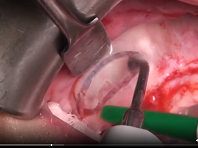 Maxillary sinus surgery: antrostomy