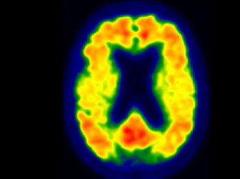 Mayo Clinic Minute: Daytime sleepiness linked to Alzheimer's