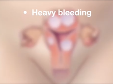 Mayo Clinic Minute: Know options for uterine fibroids