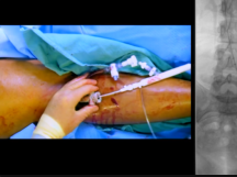 Mechanical Thrombectomy & Venous Stents: Treatment of May-Thurner Syndrome Mechanical Thrombectomy & Venous Stents: Treatment of May-Thurner Syndrome