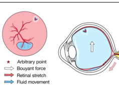 Mechanism of Retinal Displacement Following Pars Plana Vitrectomy Mechanism of Retinal Displacement Following Pars Plana Vitrectomy
