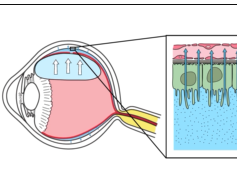 Mechanism of Retinal Reattachment Following Pneumatic Retinopexy Mechanism of Retinal Reattachment Following Pneumatic Retinopexy