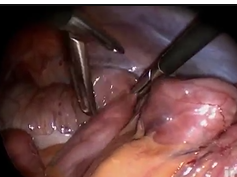 Meckel's Diverticulum: Segmental Small Bowel Resection Using Single Port Access Meckel's Diverticulum: Segmental Small Bowel Resection Using Single Port Access