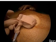 Meckel's Diverticulum: Segmental Small Bowel Resection Using Single Port Access Meckel's Diverticulum: Segmental Small Bowel Resection Using Single Port Access