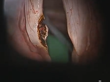 Medial Arytenoidectomies for Bilateral True Vocal Fold Paralysis