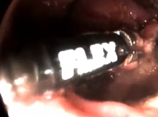 Medrobotics FLEX Transanal Excision of a Rectal GIST: First Video of Transanal Flex Robot in a Human Medrobotics FLEX Transanal Excision of a Rectal GIST: First Video of Transanal Flex Robot in a Human