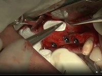 Membrane Invagination