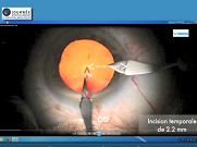 Mes trucs & astuces en chirurgie de cataracte