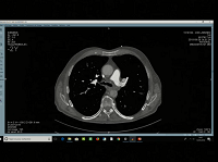 Messages essentiels dans lembolie pulmonaire