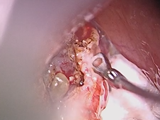 Microdirect Laryngoscopy and CO2 Laser Total Vestibulectomy for Pyolaryngocele Microdirect Laryngoscopy and CO2 Laser Total Vestibulectomy for Pyolaryngocele