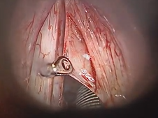 Microdirect Laryngoscopy Microflap Excision of True Vocal Fold Polyp