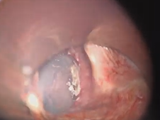 Microdirect Laryngoscopy with CO2 Laser Wedge Excisions for Subglottic Stenosis Microdirect Laryngoscopy with CO2 Laser Wedge Excisions for Subglottic Stenosis