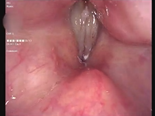 Microdirect Laryngoscopy with KTP Laser Ablation of Laryngeal Papillomas