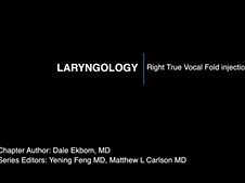 Microdirect laryngoscopy with vocal cord injection