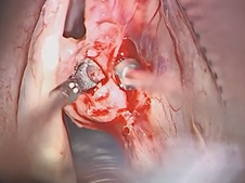 Microflap Biopsy and KTP Laser Treatment of True Vocal Cord Cancer