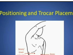 Microlaparoscopic Right Adrenalectomy