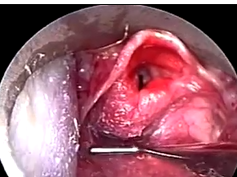 Microlaryngoscopic View of a Cushion With Blue Coloration in a 20-Month-Old Infant Microlaryngoscopic View of a Cushion With Blue Coloration in a 20-Month-Old Infant