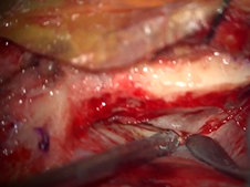 Middle Cranial Fossa Approach for Facial Nerve Decompression