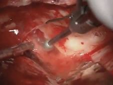 Middle Cranial Fossa Approach for Vestibular Schwannoma Excision