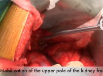 Midline Extraperitoneal RPLND in Testis Cancer: Minimizing Surgical Morbidity