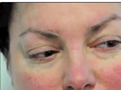 Miller Fisher Syndrome From Infliximab Miller Fisher Syndrome From Infliximab