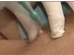 Minimal Incision Extraction Demonstration