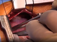 Minimally invasive atrial septal defect closure via mini-right thoracotomy