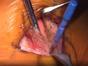 Minimally invasive atrial septal defect closure via mini-right thoracotomy