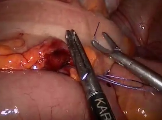 Minimally Invasive Laparoscopic Management of Colonoscopic Perforation: When & How Primary Repair Minimally Invasive Laparoscopic Management of Colonoscopic Perforation: When & How Primary Repair
