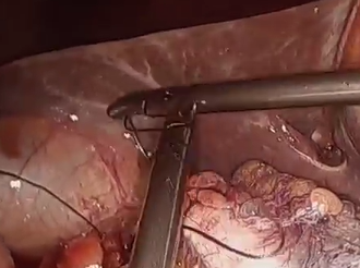 Minimally Invasive Management of Colonoscopic Perforation at Polypectomy