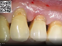Minimally Invasive Periodontal Therapy (MIST) - Work in Progress