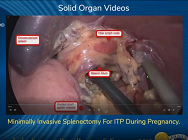 Minimally Invasive Splenectomy For ITP During Pregnancy