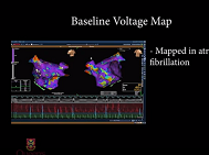 Minimally invasive thoracoscopic technique for cardiac resynchronization therapy Minimally invasive thoracoscopic technique for cardiac resynchronization therapy