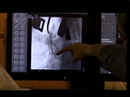 Minimally invasive transaortic transcatheter aortic valve implantatiion-CoreValve Minimally invasive transaortic transcatheter aortic valve implantatiion-CoreValve
