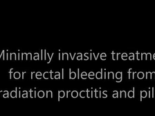 Minimally invasive treatment for radiation proctitis and piles using an Oriel Proctoscope Minimally invasive treatment for radiation proctitis and piles using an Oriel Proctoscope
