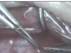 Modified Continuous Blanket Suture for Amniotic Membrane Fixation Modified Continuous Blanket Suture for Amniotic Membrane Fixation