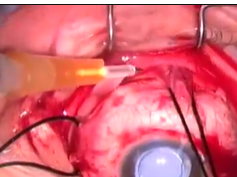 Modified External Needle Drainage of Subretinal Fluid in the Management of Rhegmatogenous Retinal De Modified External Needle Drainage of Subretinal Fluid in the Management of Rhegmatogenous Retinal De