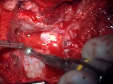 Modified Infratemporal Type B Approach Jugular Paraganglioma Resection