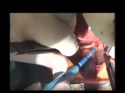 Modified Konno operation for diffuse subaortic stenosis