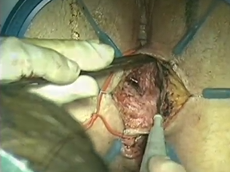 Modified Martius Graft In Rectovaginal Fistula Repair After LAR For Rectal Cancer Modified Martius Graft In Rectovaginal Fistula Repair After LAR For Rectal Cancer