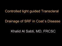 Modified Technique of Subretinal Fluid Drainage in Coats Disease Modified Technique of Subretinal Fluid Drainage in Coats Disease