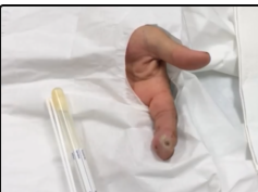 Most Popular Abscesses, Felons and Dislocated Fingers!