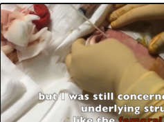 Most PUS ever drained by me! EVER!